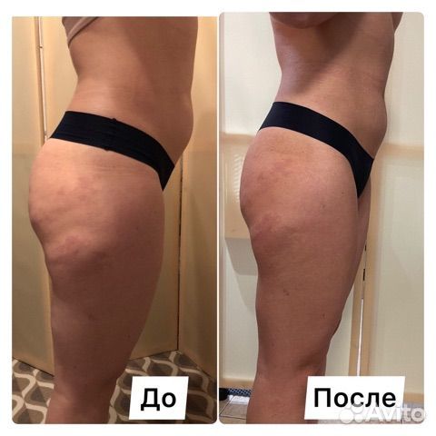 Антицеллюлитный массаж ручной