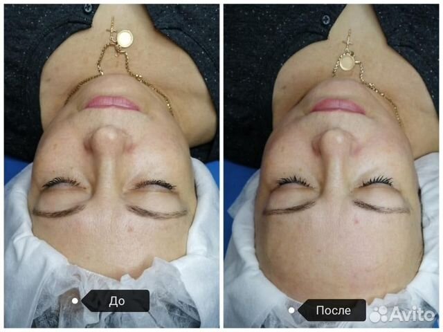 Массаж Шейно - Воротниковой зоны / Массаж Лица