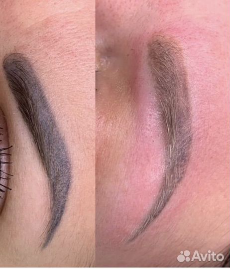 Удаление татуажа, тату