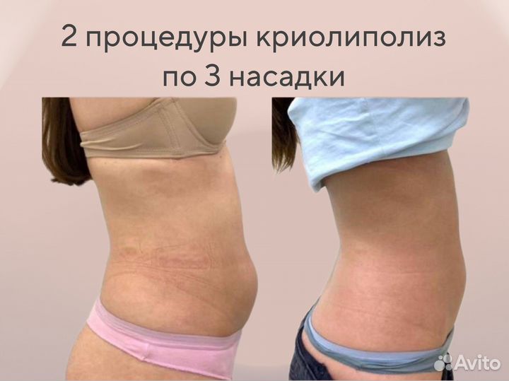 Аппаратный массаж / Криолиполиз / антицеллюлитный