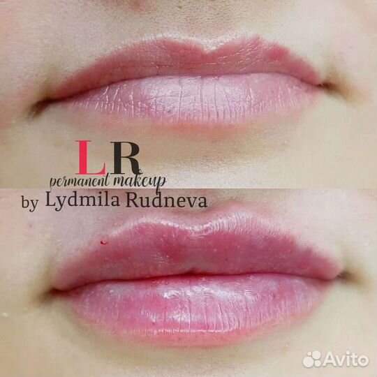 Увеличение губ