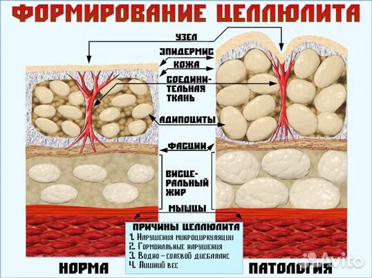 Вибромассаж для похудения
