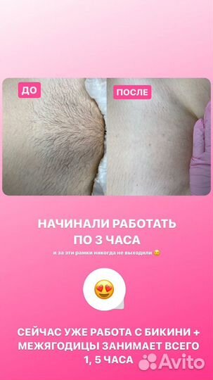 Обучение электроэпиляции