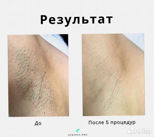 Диодный лазер для эпиляции Люминес Max One 1200