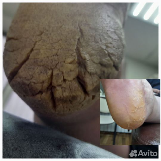 Коррекция вросшего ногтя