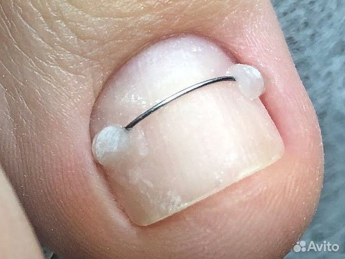 Подолог, установка титановые нити