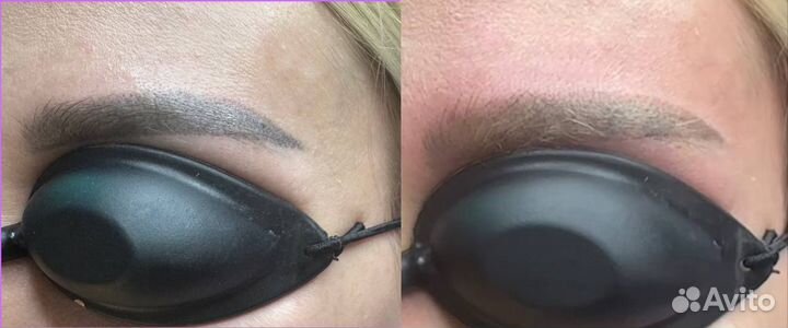 Лазерное удаление тату/татуажа/пм