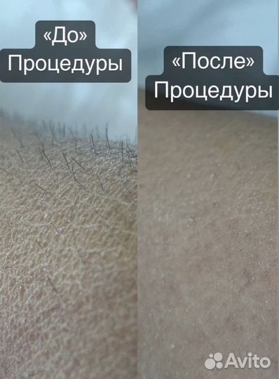 Шугаринг /Воск