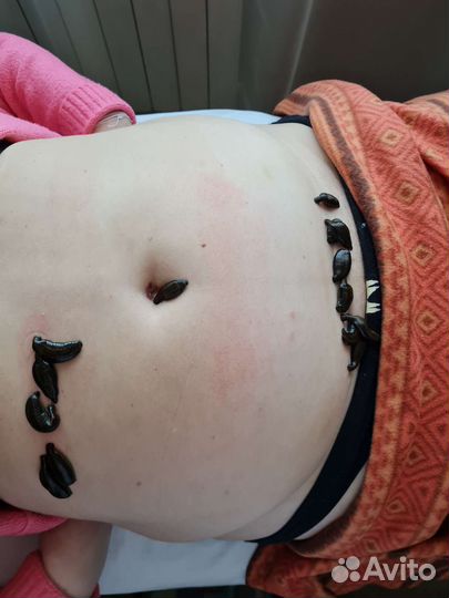 Купон на гирудотерапию