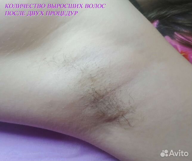 Электроэпиляция для женщин и мужчин