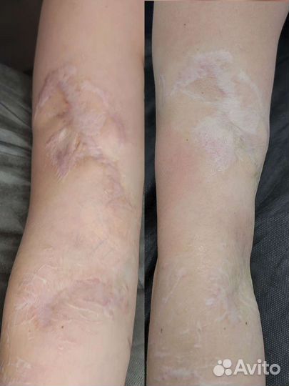 Модели на шлифовку удаление шрамов омоложение