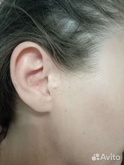 Похудение. Снижение веса микроиглами