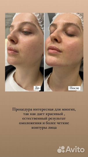 Подтяжка лица эффект с 1 процедуры