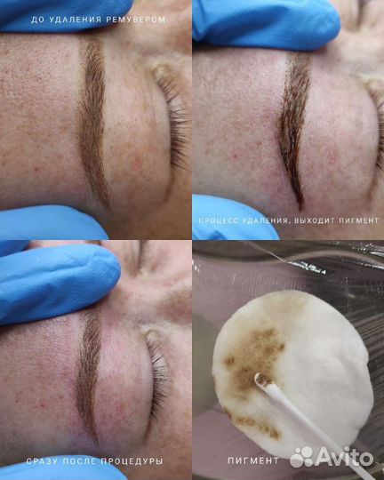Удаление татуажа лазером, ремувером