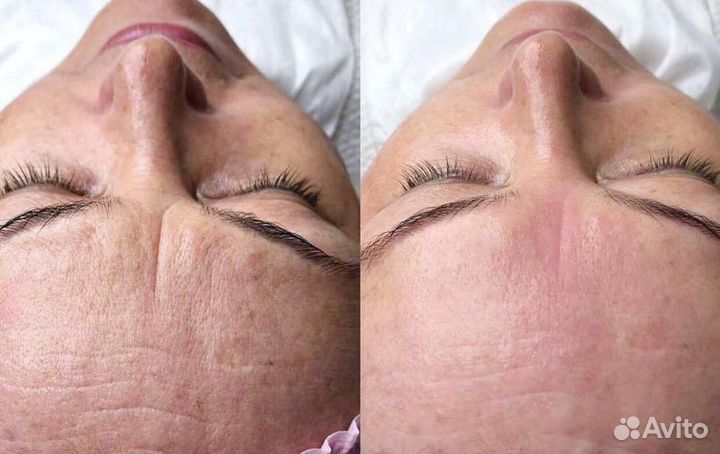 Модели Микроигольчатый RF-лифтинг