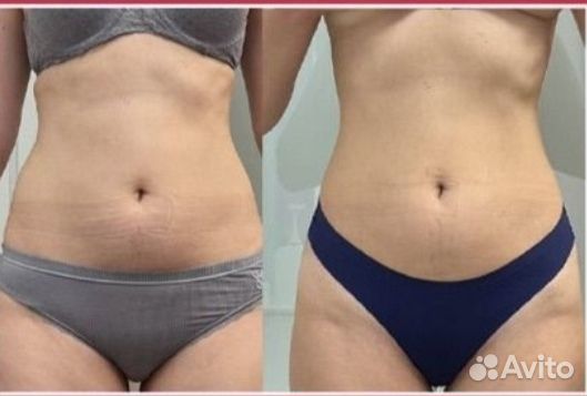 Минус 4 см за месяц. Безопасное похудение, крио