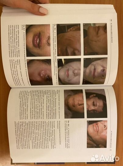 Инъекционные методы в косметологии 2018 Б. Ашера