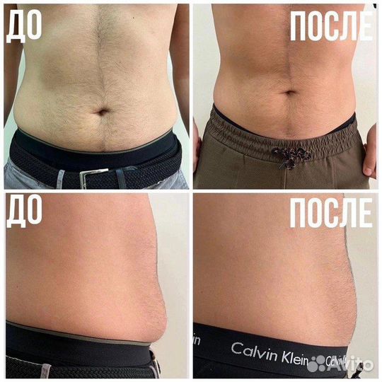 Криолиполиз