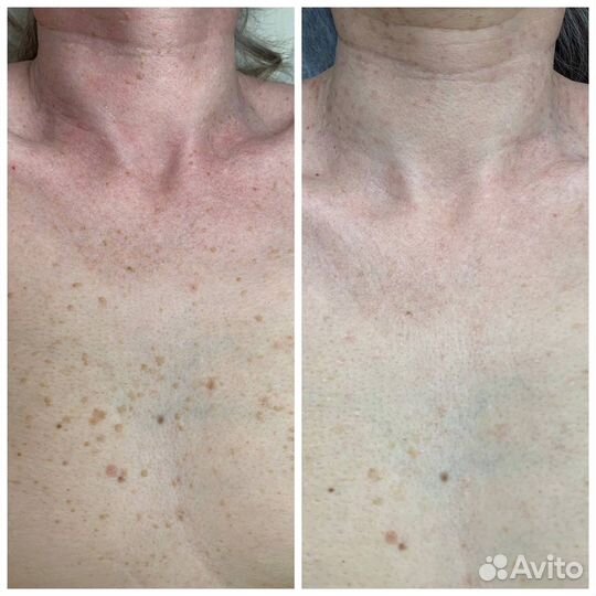 Карбоновый пилинг