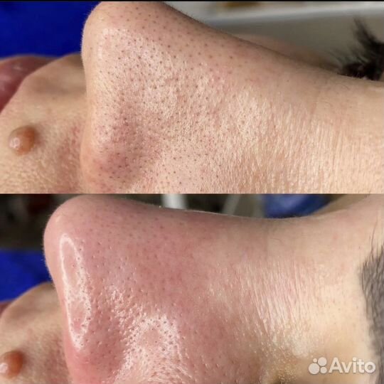 Косметолог чистка лица