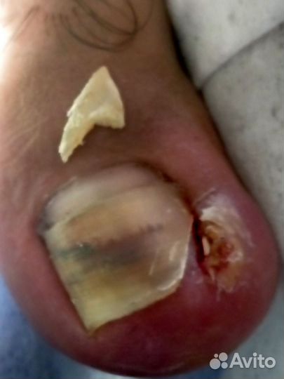 Медицинский педикюр