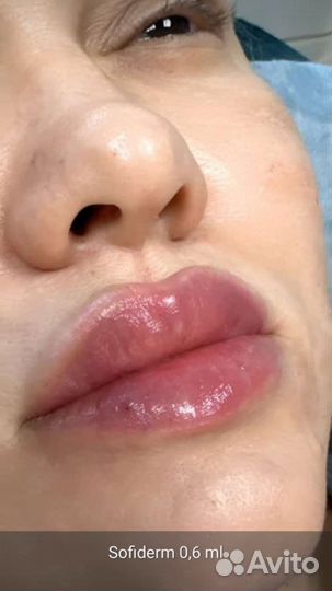 Увеличение губ