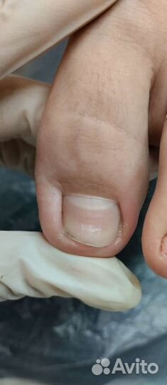 Обработка вросших ногтей и онихолизиса