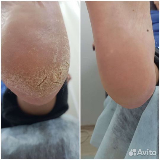 Услуга мастера педикюра/подолога, Парнас