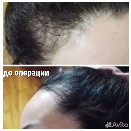 Пересадка волос в Турции