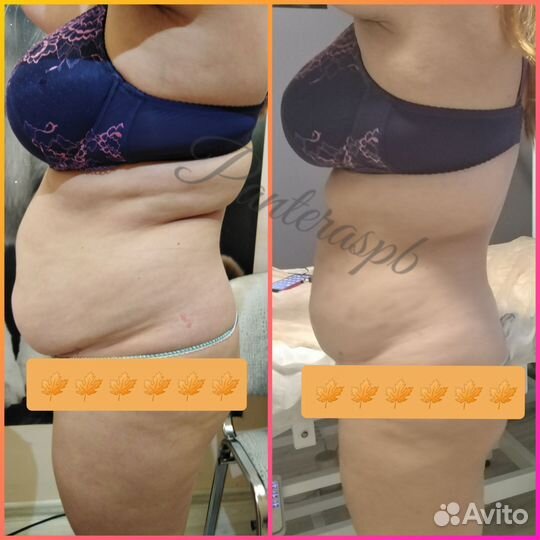 Модель на криолиполиз