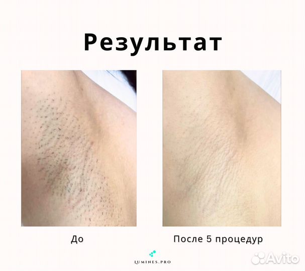 Диодный лазер для эпиляции lumines Max One 1200W