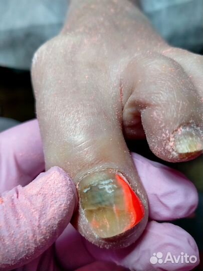 Медицинский педикюр