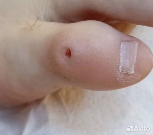 Лечебный педикюр подолог