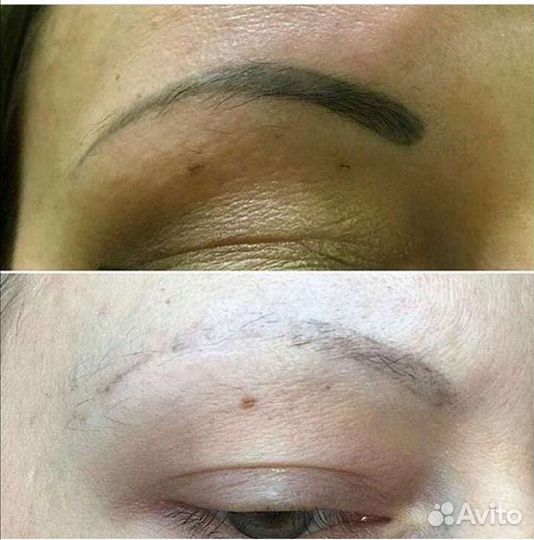 Удаление татуировок и татуажа