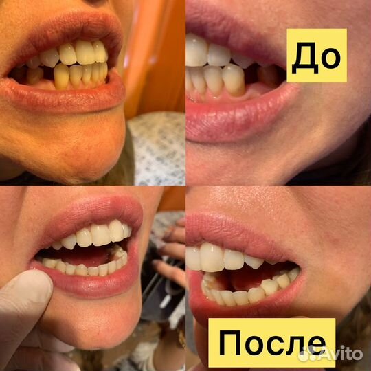 Протезирование и ремонт зубных протез