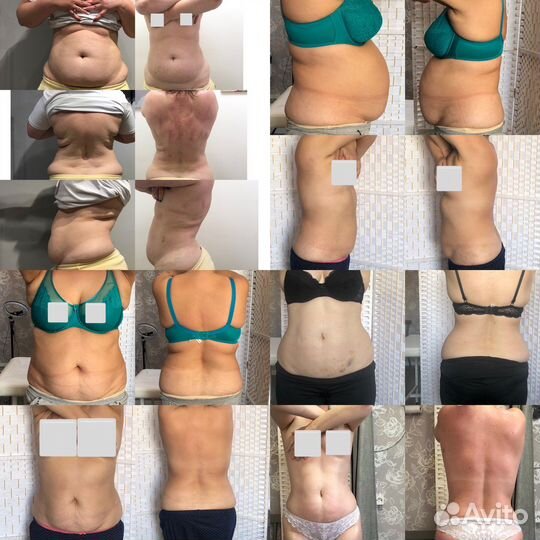 Обучение аппаратным методикам коррекции фигуры