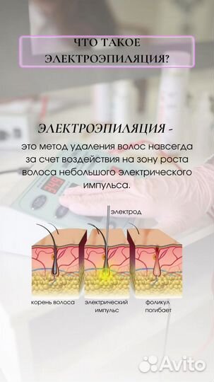 Электроэпиляция