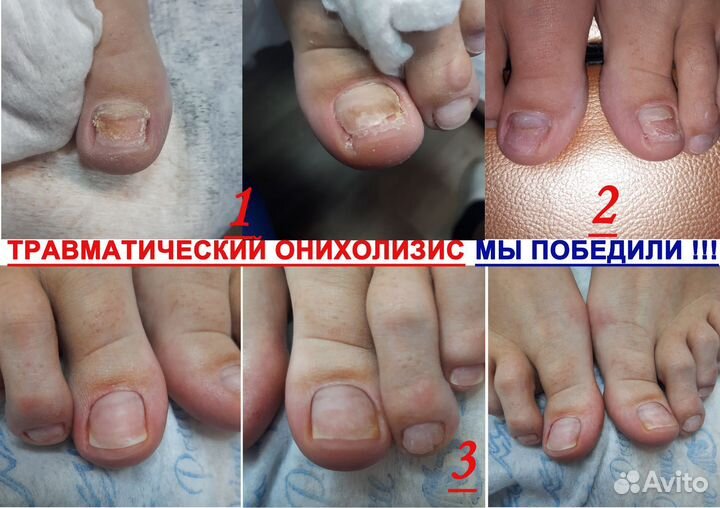 Педикюр, подолог (вросшие ногти, трещины пяток)