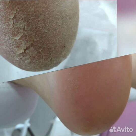 Аппаратный педикюр