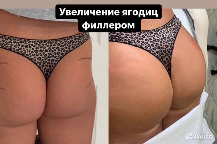 Увеличение ягодиц