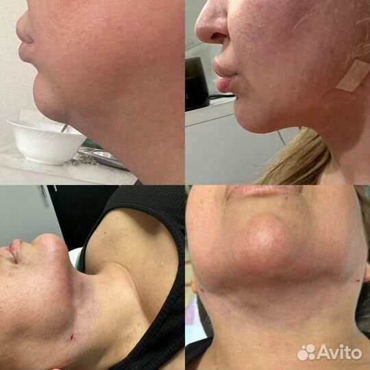 Увеличение губ. Ботокс. Липосакция подбородка