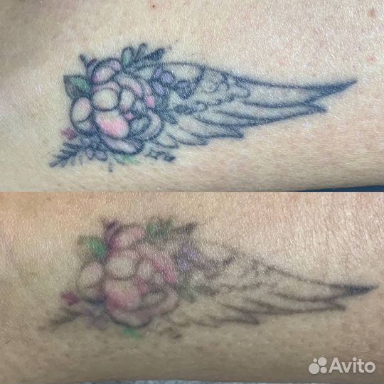 Лазерное удаление татуировки, татуаж, перманент