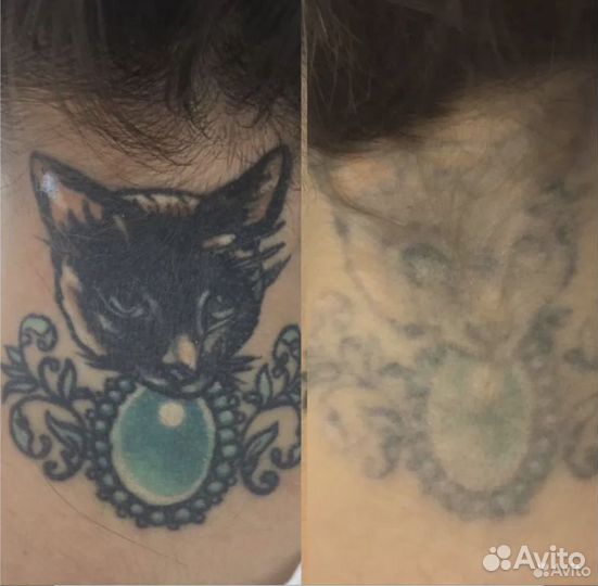 Лазерное удаление тату / татуировок / татуажа