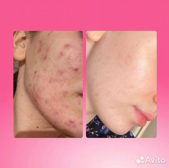 Коркйский бьюти-бокс с косметикой от акне