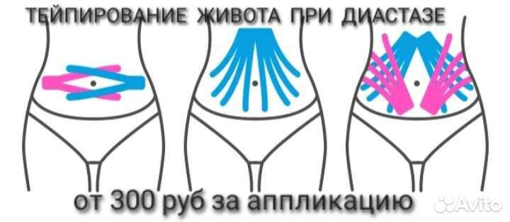 Тейпирование живота обучение