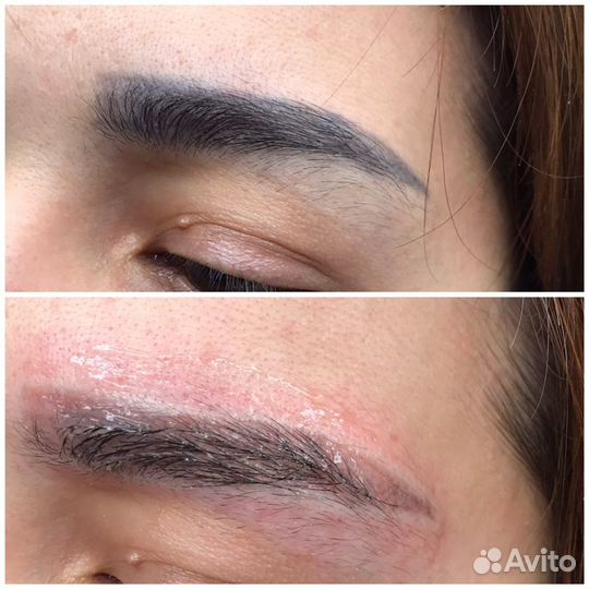 Удаление татуажа, перманентного макияжа, татуирово