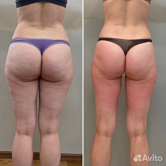 Аппаратное похудение