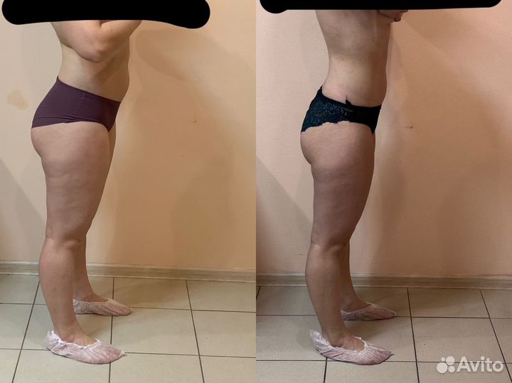 Эндо - Сфера, LPG массаж,вакуумный,корекция фигуры