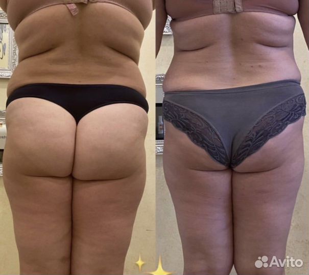 Криолиполиз