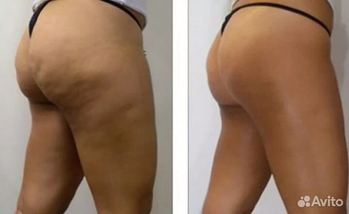 Антицеллюлитный массаж